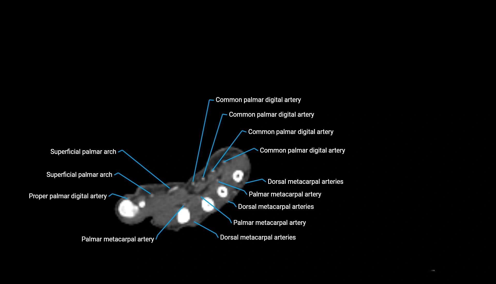 CTA upper limb axial cross sectional anatomy labelled image 58 (2).webp